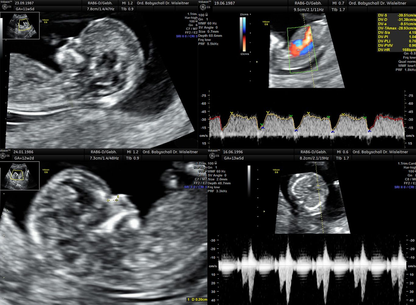 Ultraschall Bild | Ersttrimesterscreening